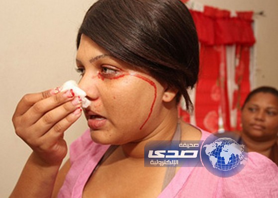 فتاة من جمهورية الدومينيكان تبكي وتتعرق دماً