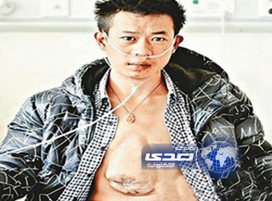 وفاة شاب عاش وقلبه خارج صدره