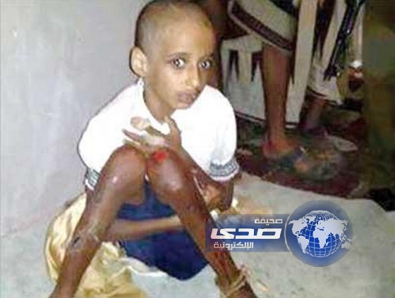 حلق شعر فتاة يمنية ونزع أظافرها لاعتقاده بأنها ترسل له السحر والجن