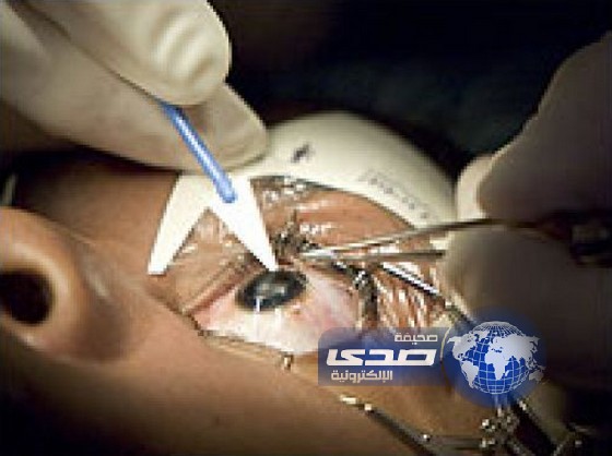 استئصال دودة طولها 12 سنتمتراً من عين سيدة خمسينية