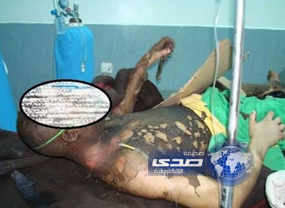 شاب يمني يحرق نفسه حتى الموت بسبب عدم زواجه من أبنته عمة !