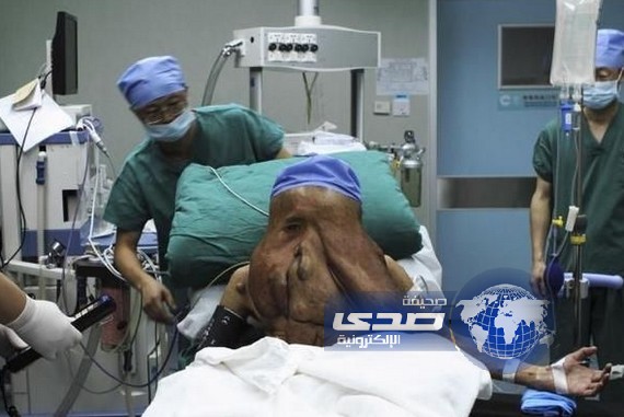“الرجل الفيل” يخضع لجراحة لإزالة 3 أورام من وجهه