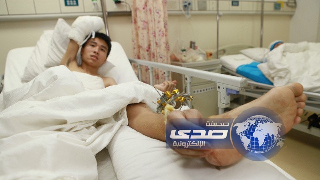 أطباء صينيون يخيطون يد مريض محل رجله لإنقاذه