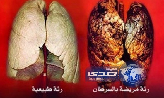 اقتراح علاج بديل لسرطان الرئة