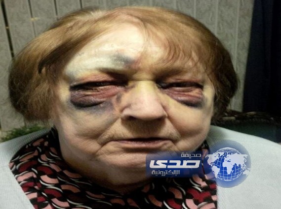 تفقيع وجه ثمانينية بسبب نصيحة قدمتها عن مضار التدخين