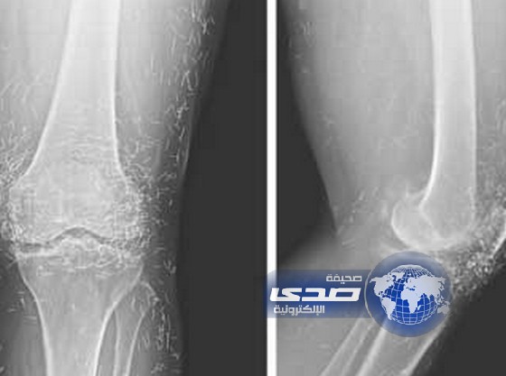 اكتشاف معدن من الذهب في ركبة امرأة