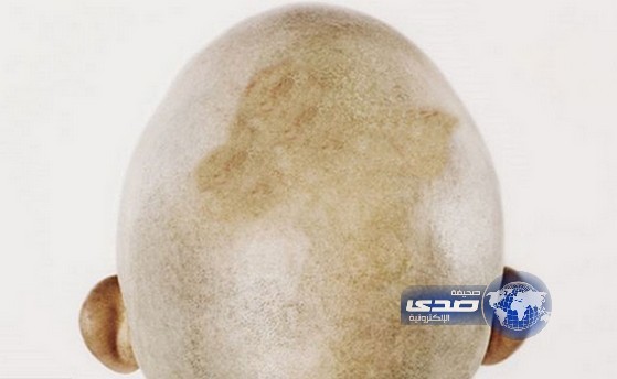 علماء يخترعون علاجًا يقضي على الصلع نهائيًا