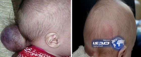 بالصور..ولادة طفلة بدماغ خارج الجمجمة