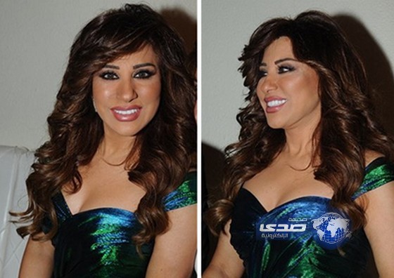 لجوء المطربة نجوى كرم لحقن البوتكس والفيلرز