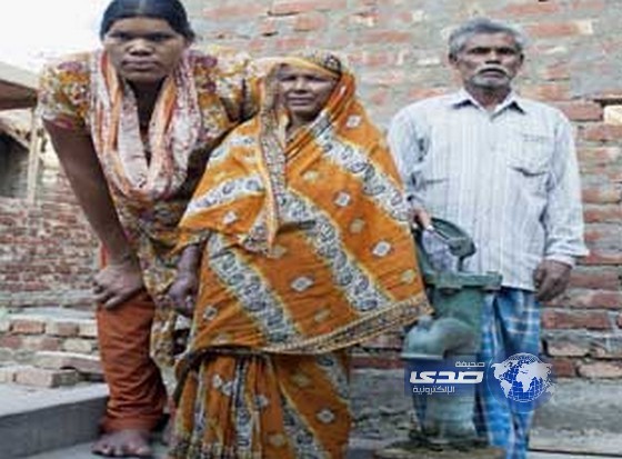 أطول امرأة في العالم تتوقف عن النمو بعملية جراحية