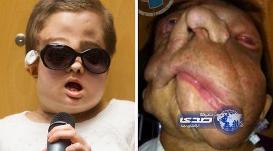 زراعة وجه جديد لامرأة بولندية عانت من ورم تسبب بتشوه وجهها