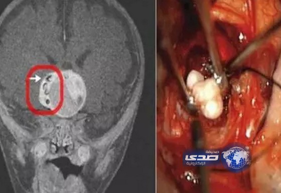 العثور على”سن بشري” ينمو في دماغ رضيع