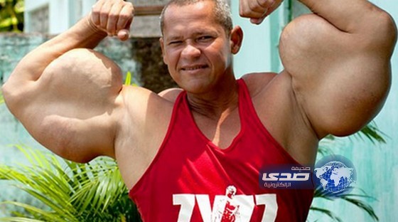 بالصور.. يحقن ذراعه بكوكتيل مميت للحصول على عضلات “باباي”