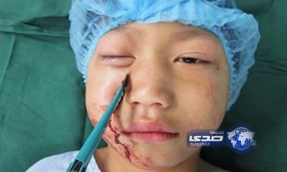 مقص يخترق وجه طفل صيني