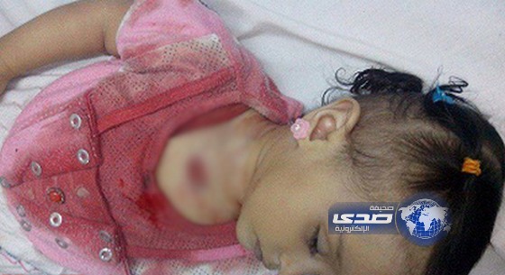 وفاة طفلة يمنية بعد اصابتها برصاصة أطلقت من احد الاعراس