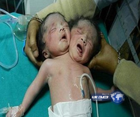 بالفيديو.. طفلة برأسين ورقبتين وجسم واحد