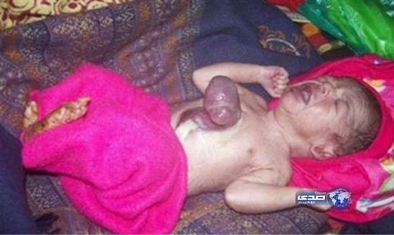 طفل هندي يولد بقلب خارج جسدة