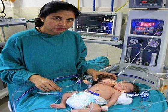 وفاة التوأم الهندي الملتصق والأم رفضت احتضانهما قبل وفاتهما