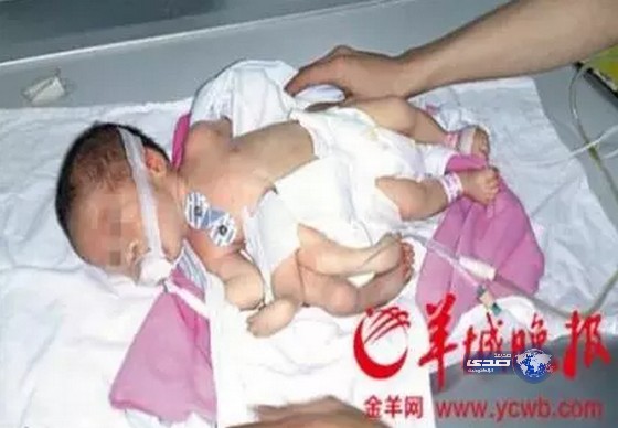 رضيع صيني يولد بـ 4 أطراف زائدة