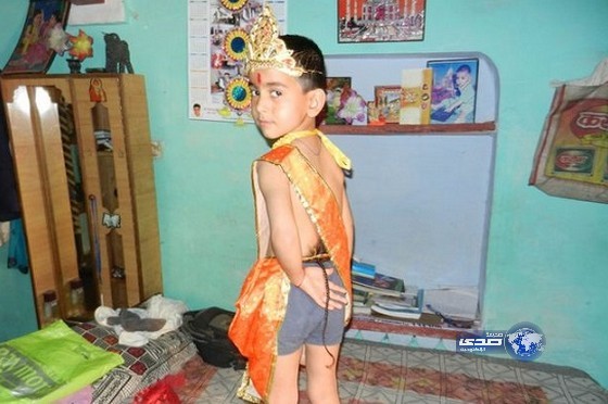 بالصور :طفل هندي ينبت له ذيل طوله 12 بوصة