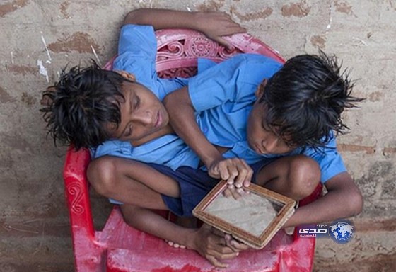 بالفيديو.. أغرب توأم ملتصق في العالم