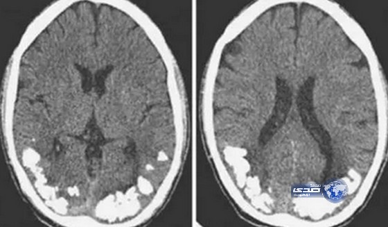 أحجار كلسية في دماغ رجل منذ 10 سنوات