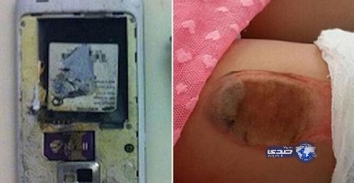 انفجار هاتف ذكي بجيب فتاة صغيرة