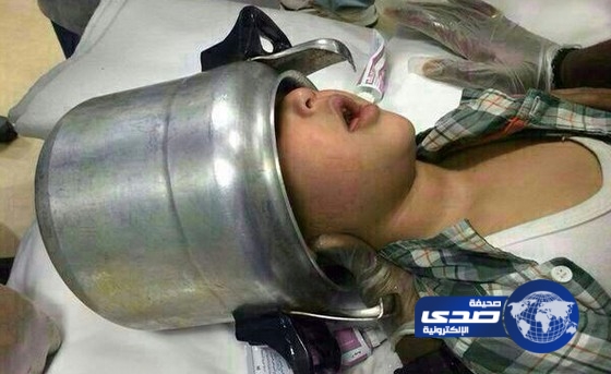 إنقاذ طفل علق رأسه في قدر ضغط