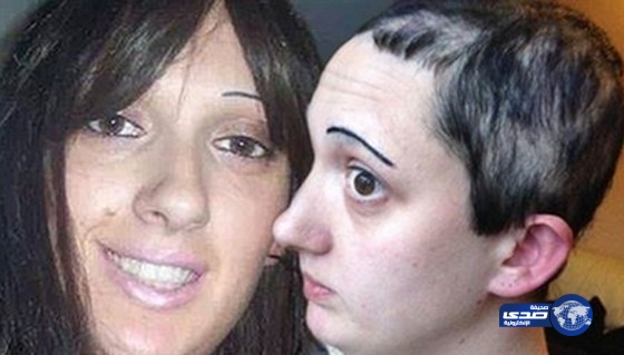 أعراض نادرة ترغم امرأة على “نتف” شعرها