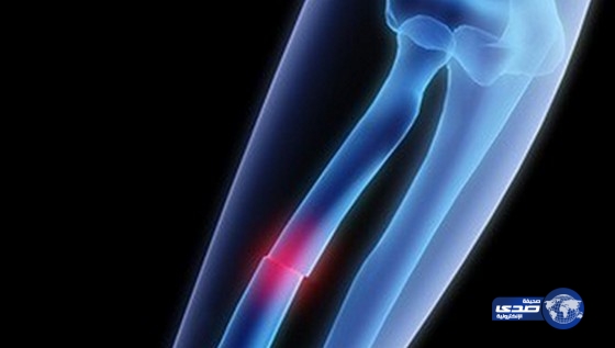 بالفيديو : ابتكار هلام ذكي لتجبير كسور العظام