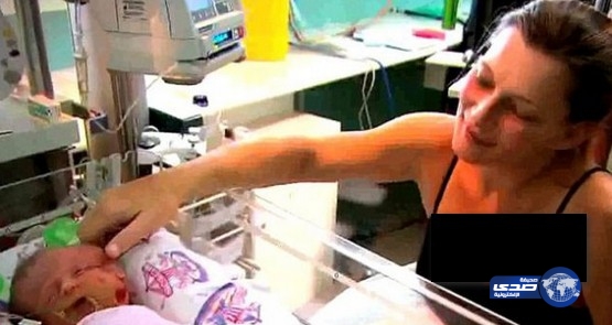 أسترالية تلد توأم بوجهين وجسد واحد