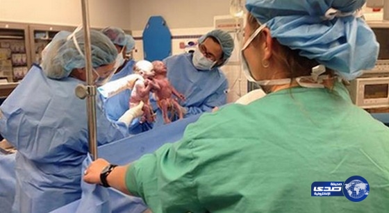 بالفيديو..طفلتان توأم تخرجان من رحم والدتهما بأيادٍ متشابكة