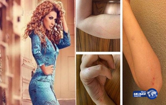 إصابة ميريام فارس خلال تصوير “اتهام”