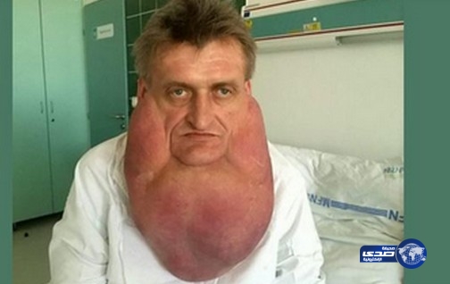 استئصال ورم يزن 6 كلغ من رقبة رجل