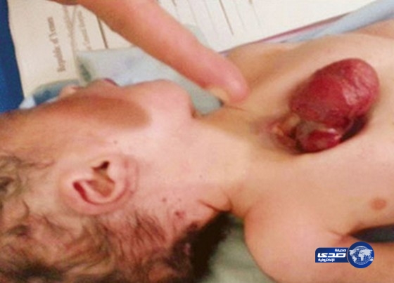 ولادة طفل يمني قلبه خارج القفص الصدري