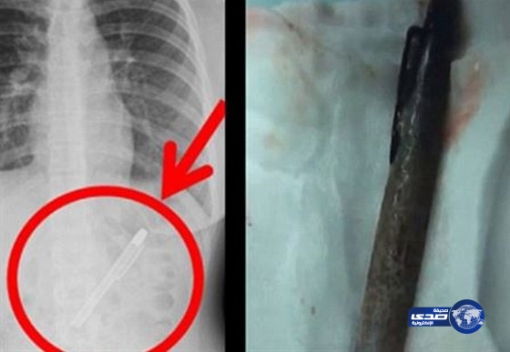فتاة احتفلت بنهاية الامتحانات وابتلعت قلم نسيته في معدتها ستة أشهر
