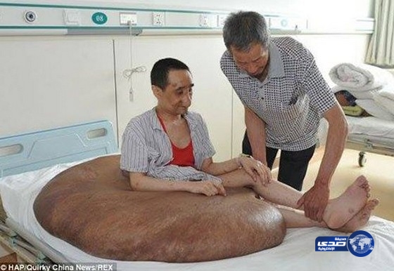 إزالة أكبر ورم سرطاني في العالم من مريض