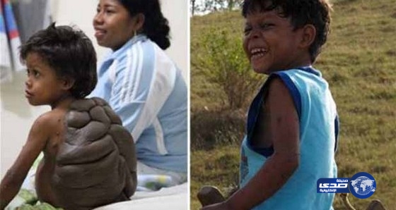 طفل يولد بظهر سلحفاة!