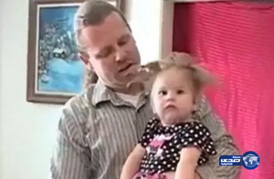 مرض غريب يوقف شعر طفلة أمريكية تعرضت والدتها لصاعقة أثناء الحمل