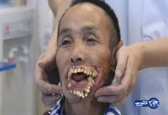 عضة ذئب تحول صينياً إلى “وجه مشوه” منذ 56 عاماً