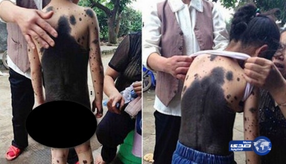 طفلة صينية تتحول إلى قطة لإصابتها بمرض جلدى نادر