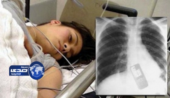 فتاة إبتلعت هاتفها كي لا يكتشف صديقها خيانتها