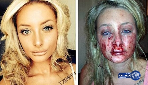 شاب يشوه وجه ملكة جمال لغيرته عليها