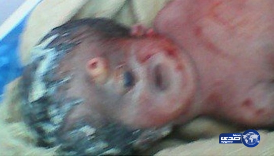 ولادة طفل بعين واحدة وأنف على شكل “مسمار” في مصر