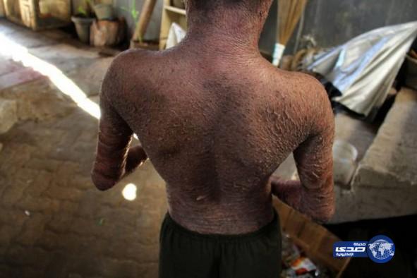 “الصبي الثعبان”.. يغير جلده كل يومين