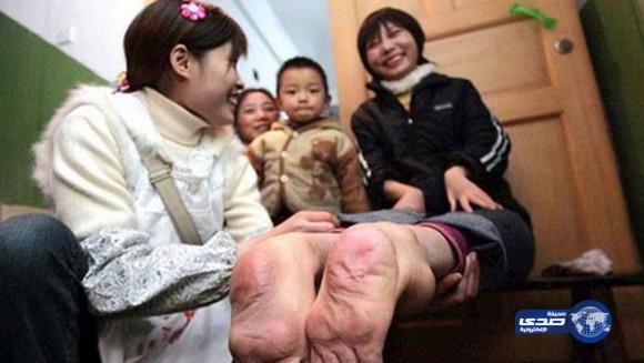 بالصور.. فتاة وُلدت بقدمين مقلوبتين