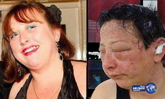 سيدة مهددة بالعمى.. بسبب “صبغة شعر”