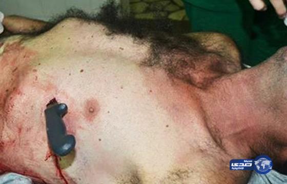 شاب عاشق يغرس سكين في قلبه بسبب خلافات مع حبيبته (صور)