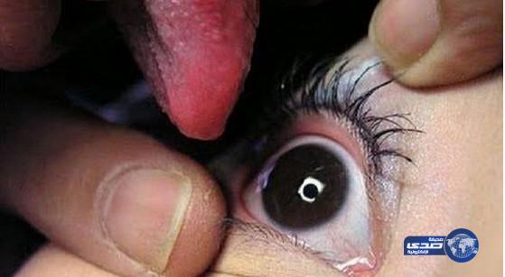 بوسنية عجوز تعالج أخطر أمراض العين بـ”لسانها”