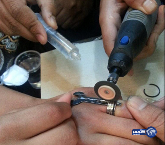 مدني حائل: تحرير أحد أصابع شاب من خاتم حديدي